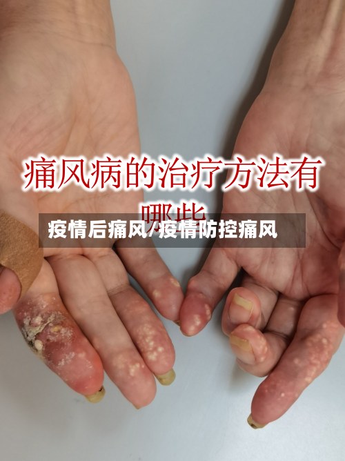 疫情后痛风/疫情防控痛风-第2张图片