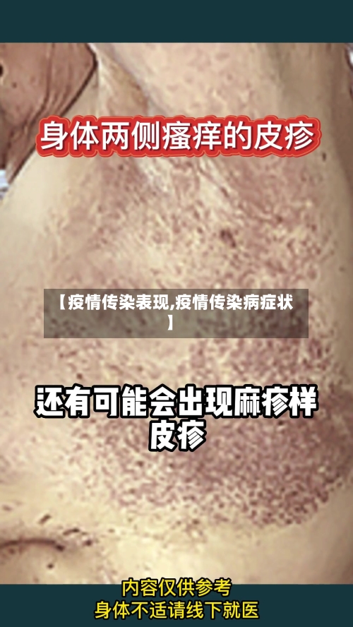 【疫情传染表现,疫情传染病症状】-第3张图片