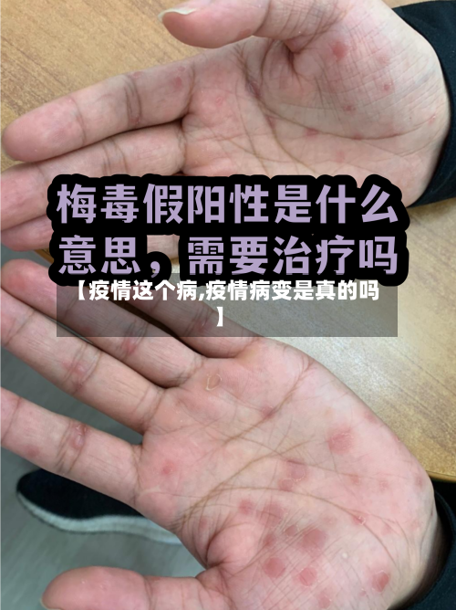 【疫情这个病,疫情病变是真的吗】